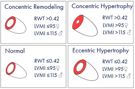 lv mass calculator|relative wall thickness calculator.